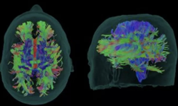 Yeni Alzheimer ilacı 'donameab' hastalığın ilerlemesini yavaşlatıyor