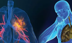 Akciğer Kanseri Görülme Yaşı Düşüyor: Göğüs Cerrahisi Uzmanları Uyarıyor